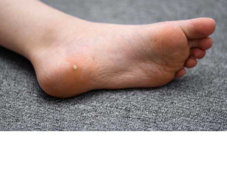 “Why Won’t My Plantar Warts Go Away?”