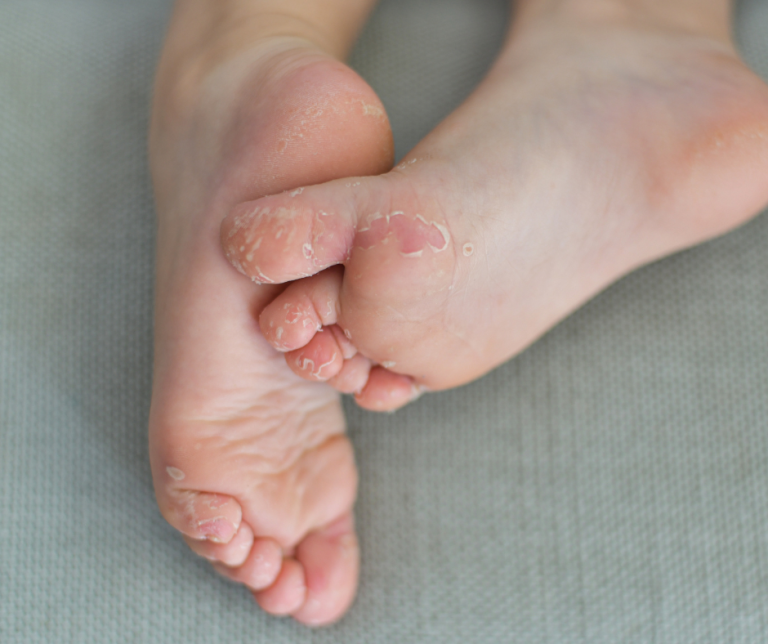 Are Your Kid’s Feet Looking Red? 